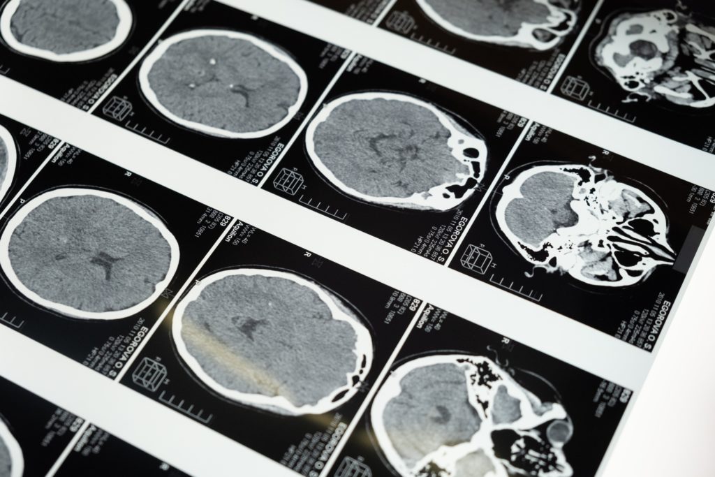 MRI of the brain in a case of Lance-Adams syndrome may show variable findings